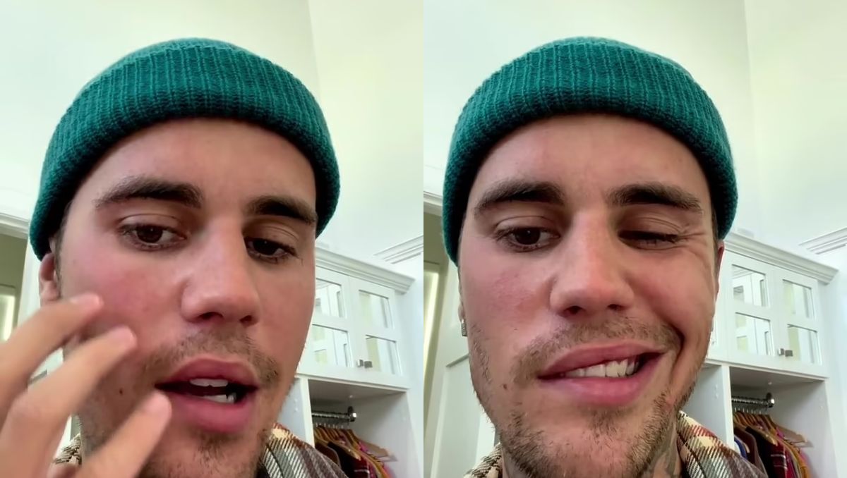 Justin Bieber sufre de parálisis facial